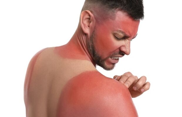 How Do You Treat Sunburn?